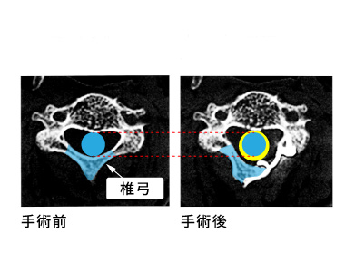 頚椎椎弓形成術